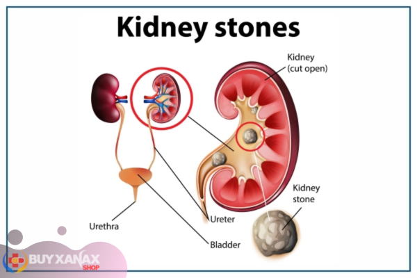 kidney stone pain